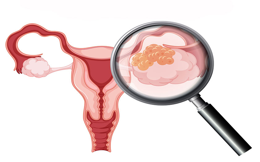 cancer epitelial de ovario